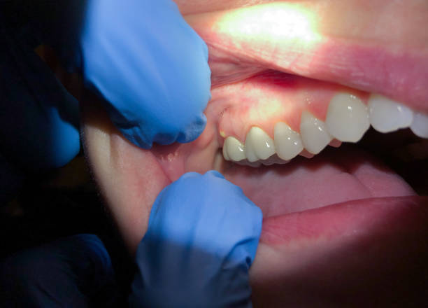 Best Urgent Tooth Repair  in Bloomington, TX